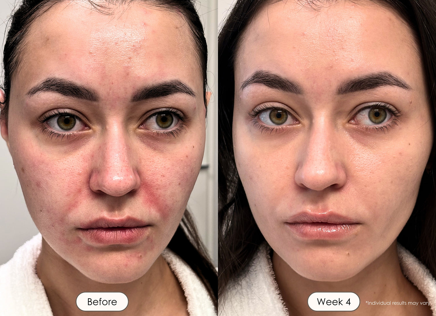 Woman revealing her skin transformation after 4 weeks of consistent LED light therapy.
