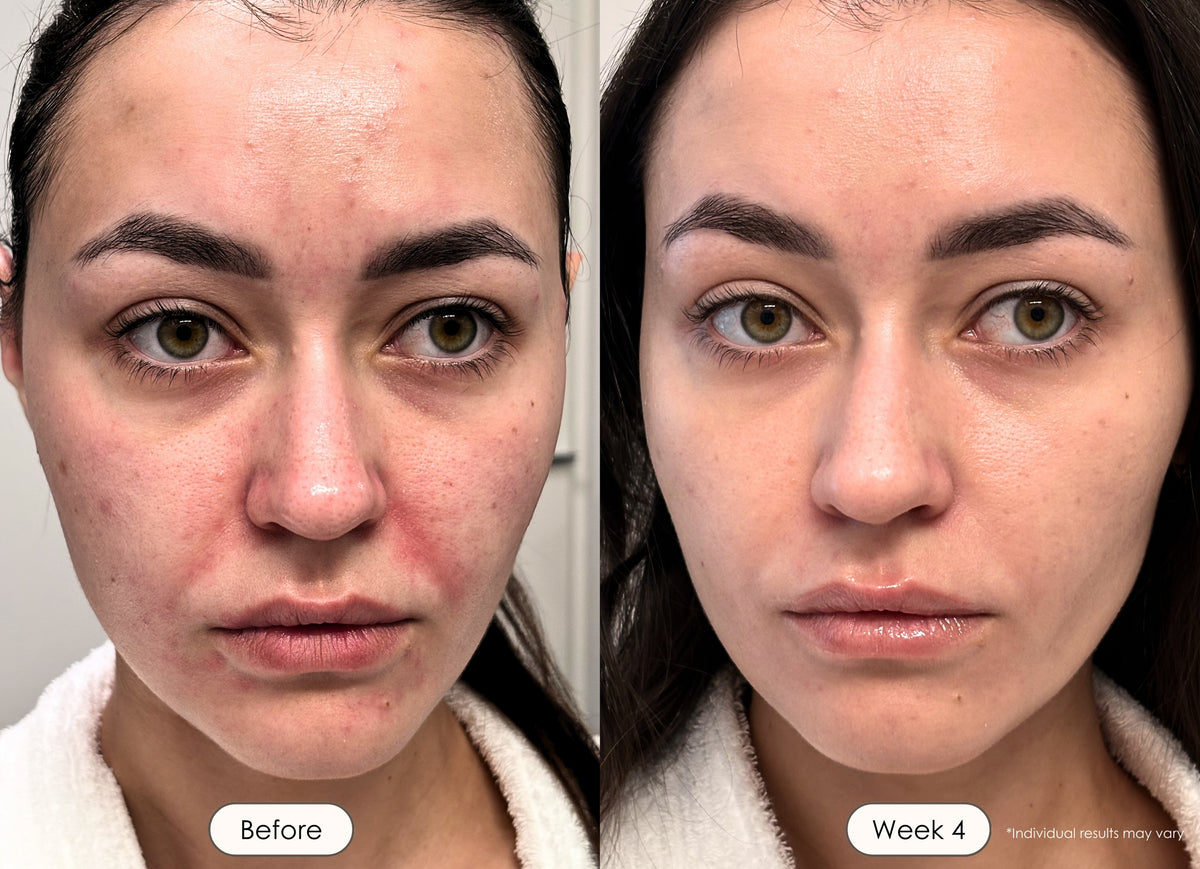 Woman revealing her skin transformation after 4 weeks of consistent LED light therapy.