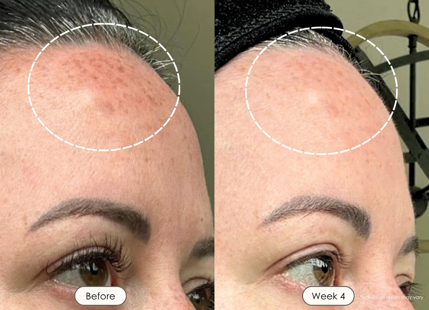 Close-up before and after comparison of forehead of a woman skin showing reduced redness and improved texture after 4 weeks of LED light therapy.