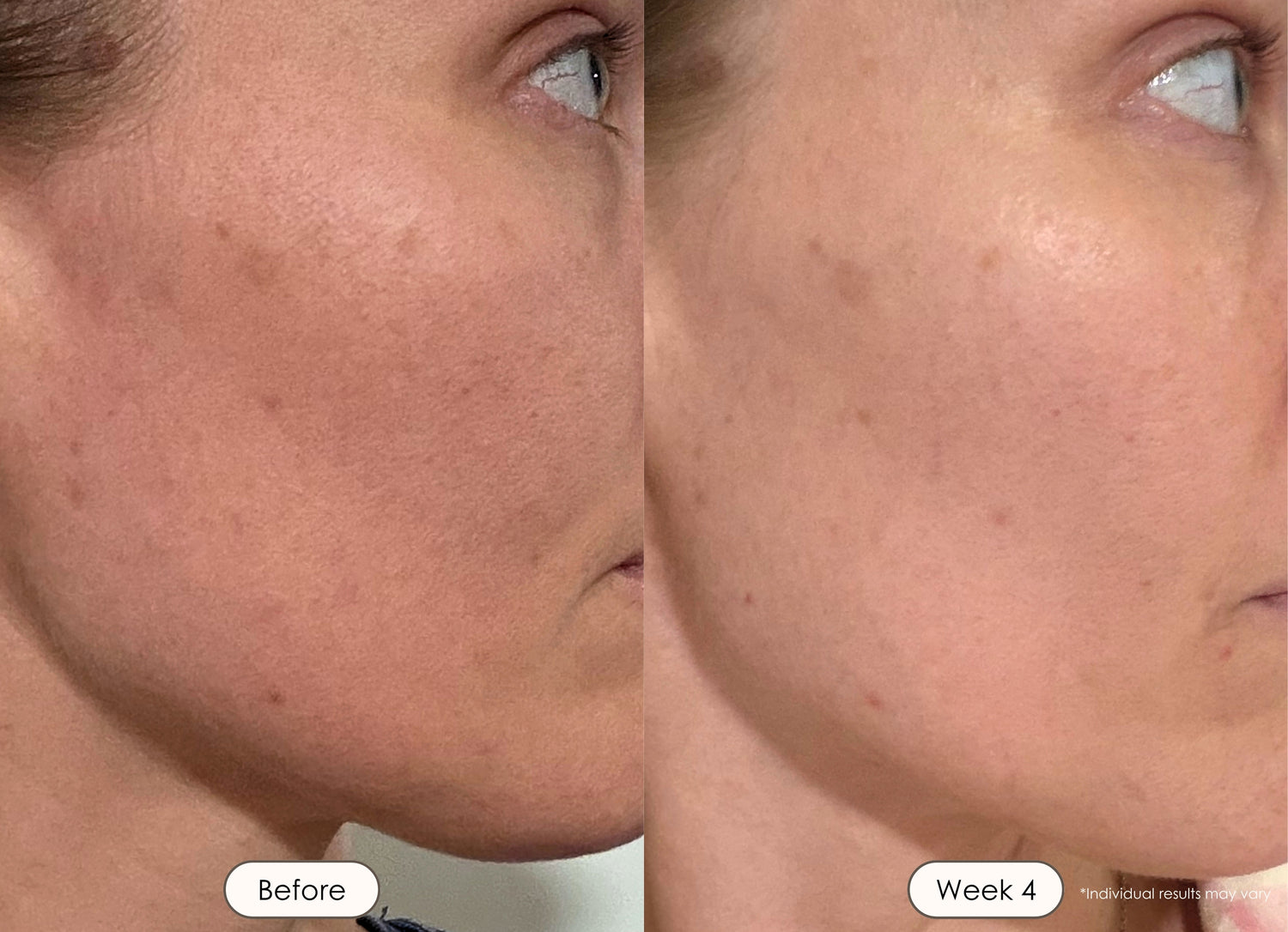 Woman's cheek skin transformation showing faded blemishes and hyperpigmentation at week 4.