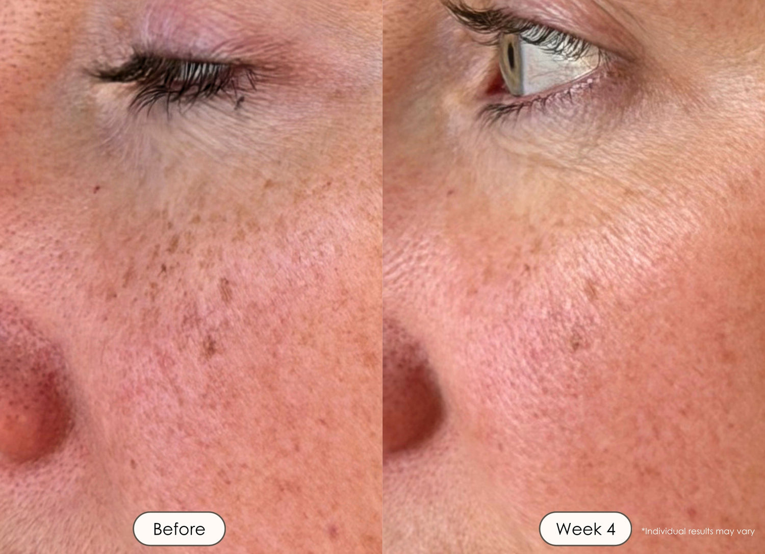 Close-up of under-eye and cheek skin showing improved tone after 4 weeks.