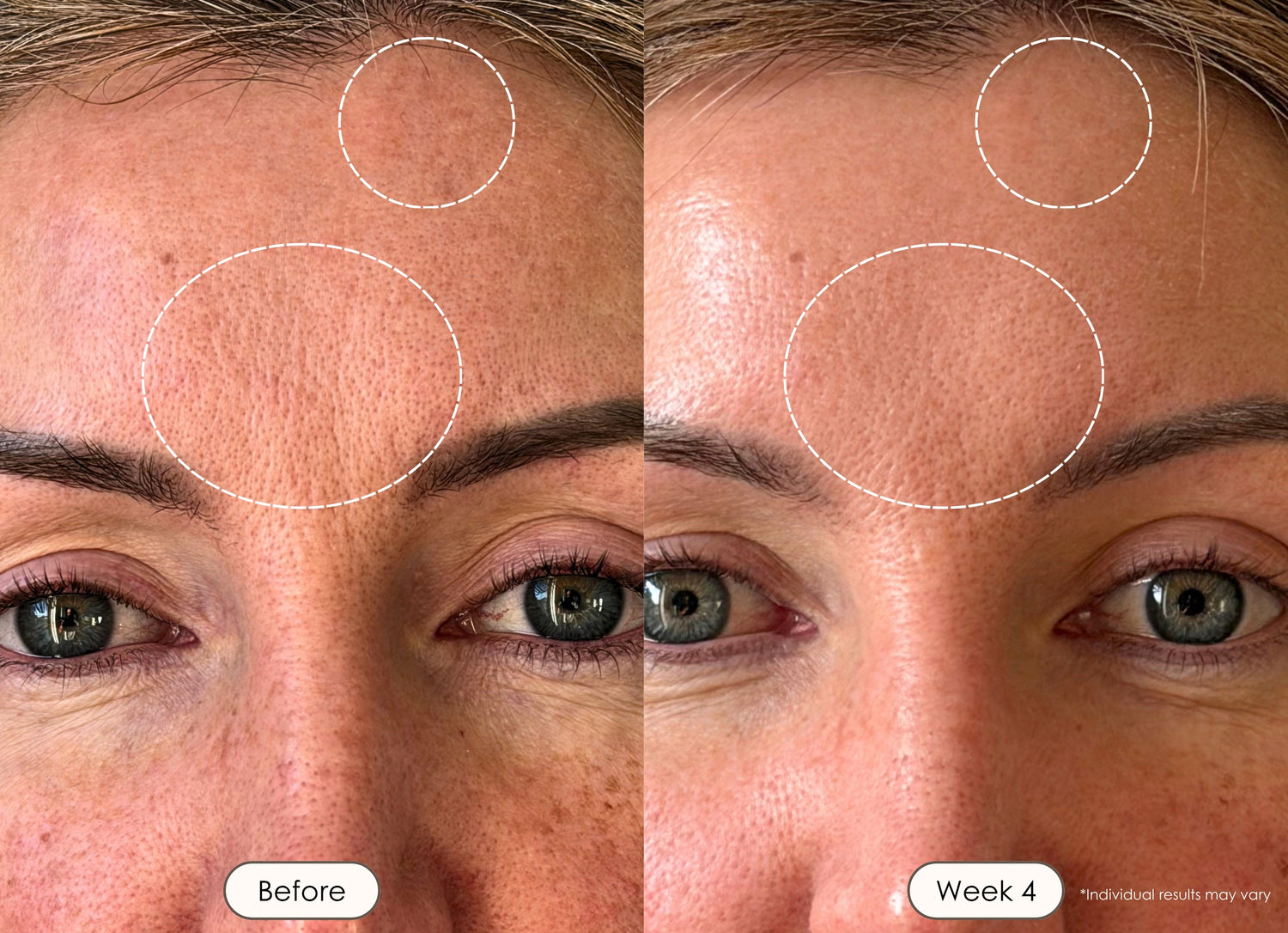 Close-up of under-eye and cheek skin showing improved tone after 4 weeks.